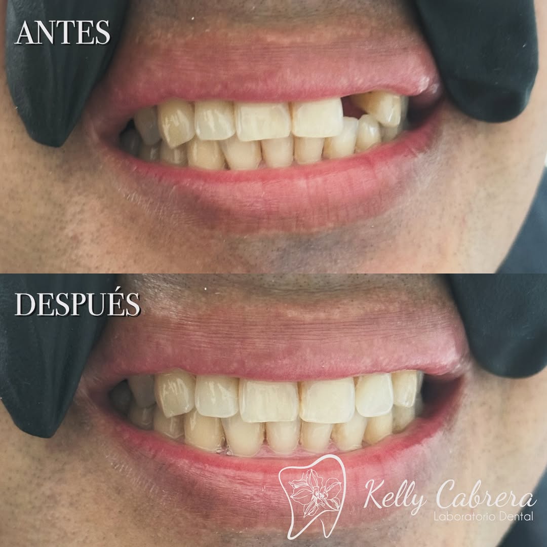 Antes y Después