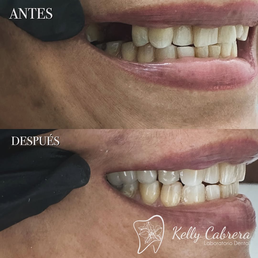 Antes y Después