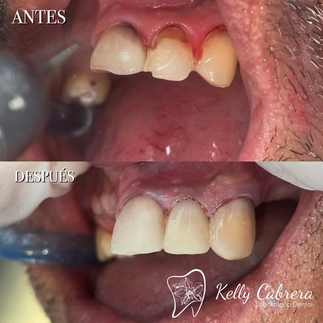 Antes y Después